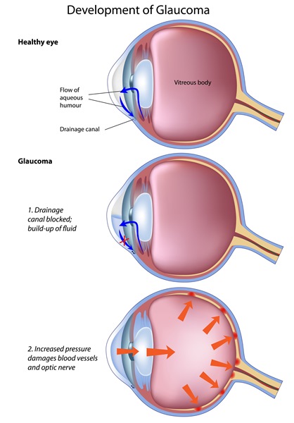 QEC  Learn - Glaucoma, Quality Eye Associates, Quality Eye Care
